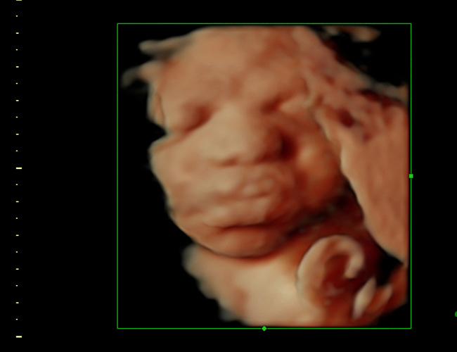 3D ultrasound image at s_ weeks